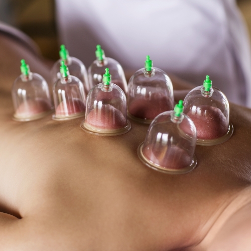 Cupping-Physical-Therapy-Center-Waxham-Monroe-Charlotte-Matthews-NC