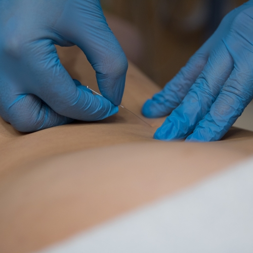 Dry-Needling-Physical-Therapy-Center-Waxham-Monroe-Charlotte-Matthews-NC